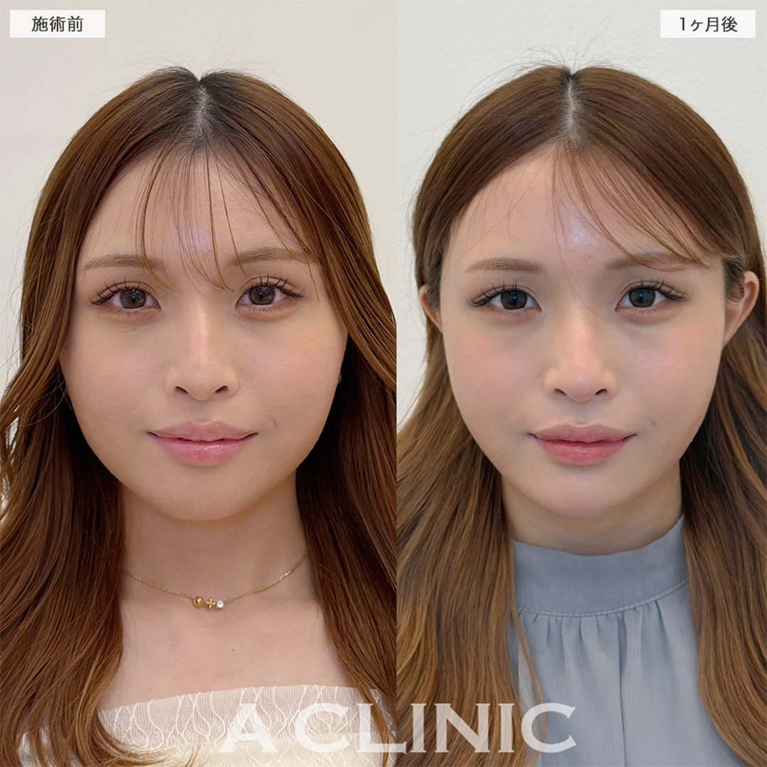1day小顔脂肪吸引で他撮りに自信がつきました！こちら処置前と1ヶ月後の症例です(20代女性)