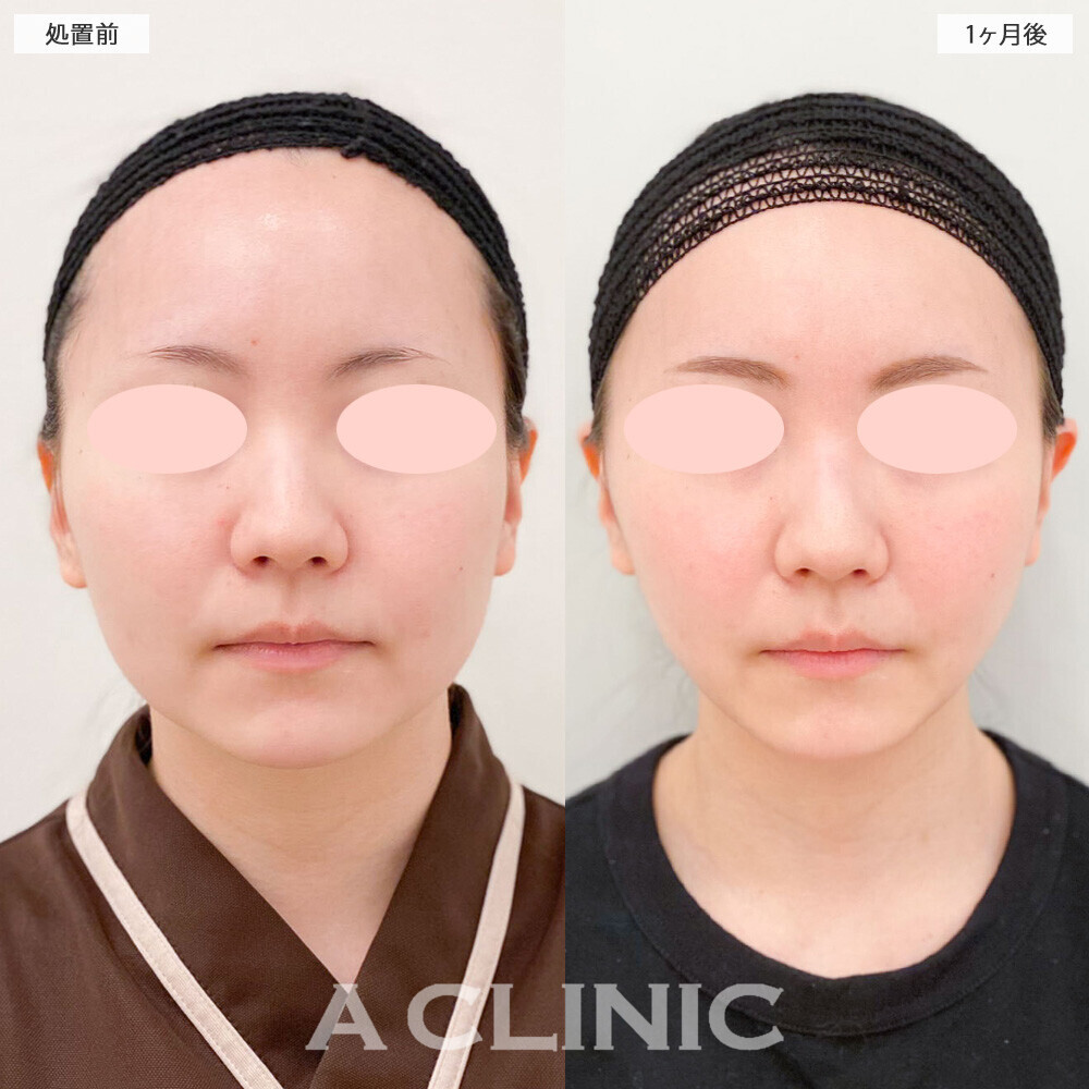1day小顔脂肪吸引でフェイスラインがスッキリとした印象に！処置前から2ヶ月後の症例です(20代女性)