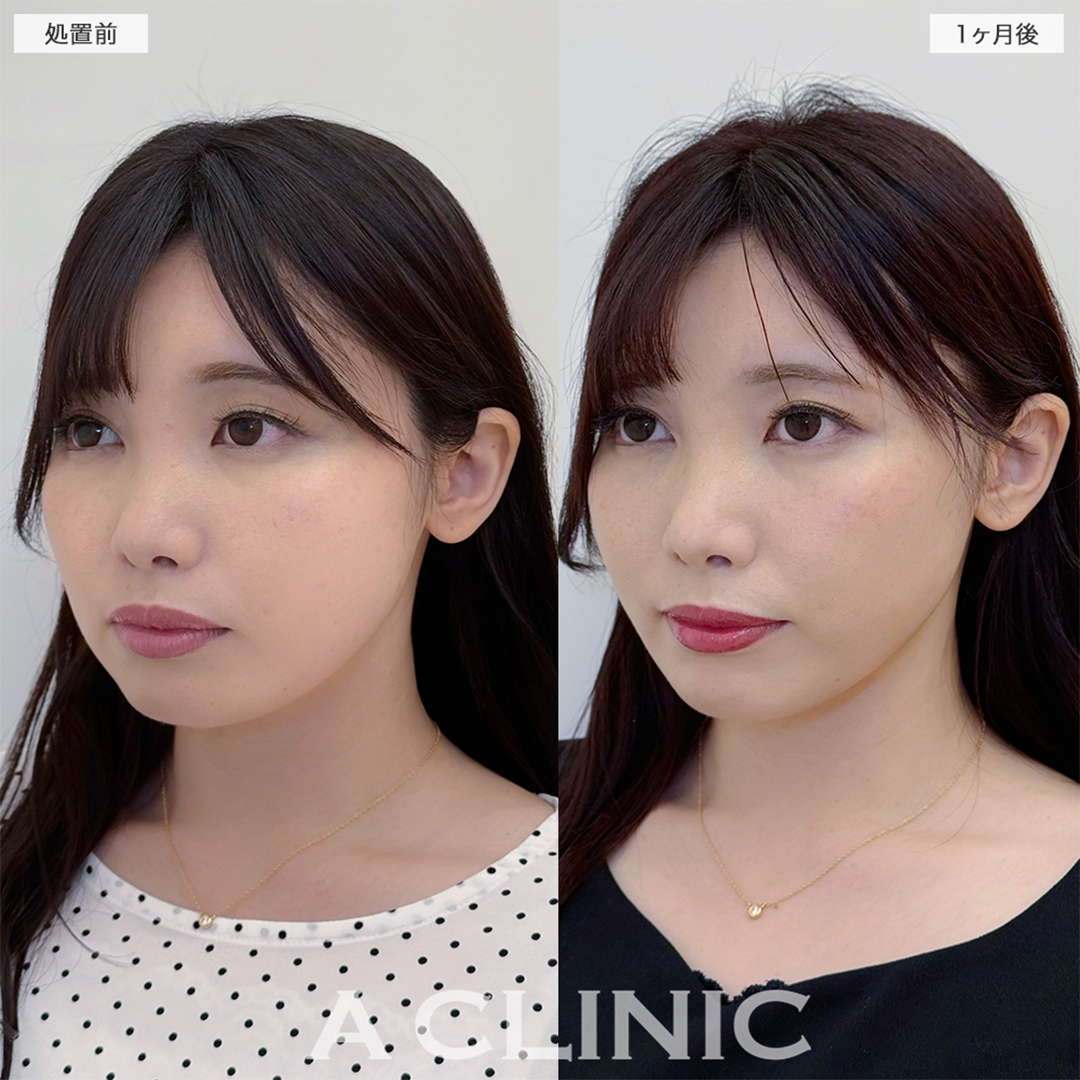 1day小顔脂肪吸引は経過とともに可愛さアップします！こちら処置前と1ヶ月後の症例です(30代女性)