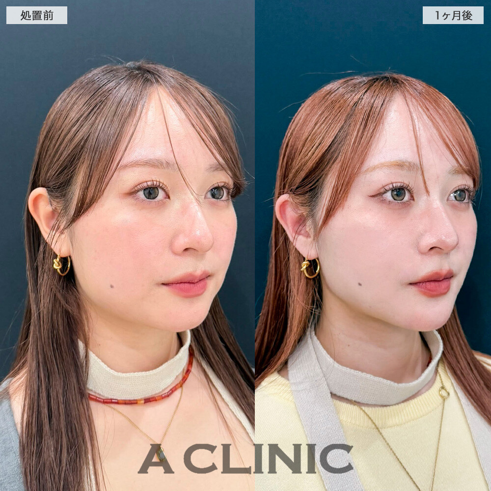 1day小顔脂肪吸引が顔の余白を無くしてくれました！こちら処置前と１ヶ月後の症例です(20代女性)