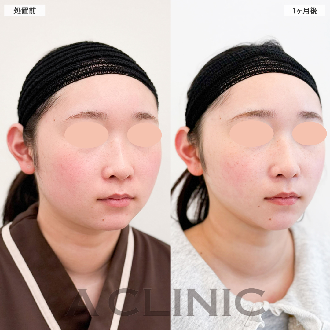 1day小顔脂肪吸引で輪郭がハッキリしました！こちら処置前と1ヶ月後の症例です(20代女性)
