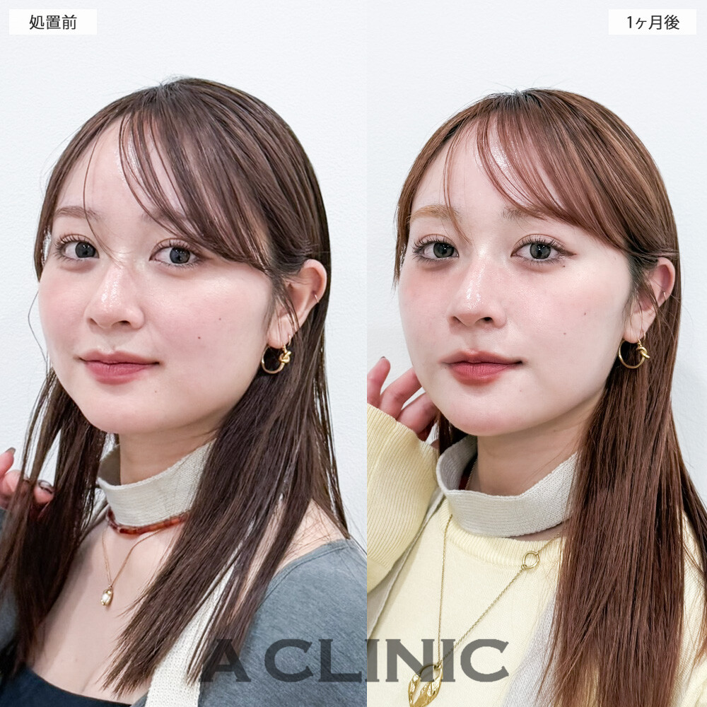 1day小顔脂肪吸引が顔の余白を無くしてくれました！こちら処置前と１ヶ月後の症例です(20代女性)