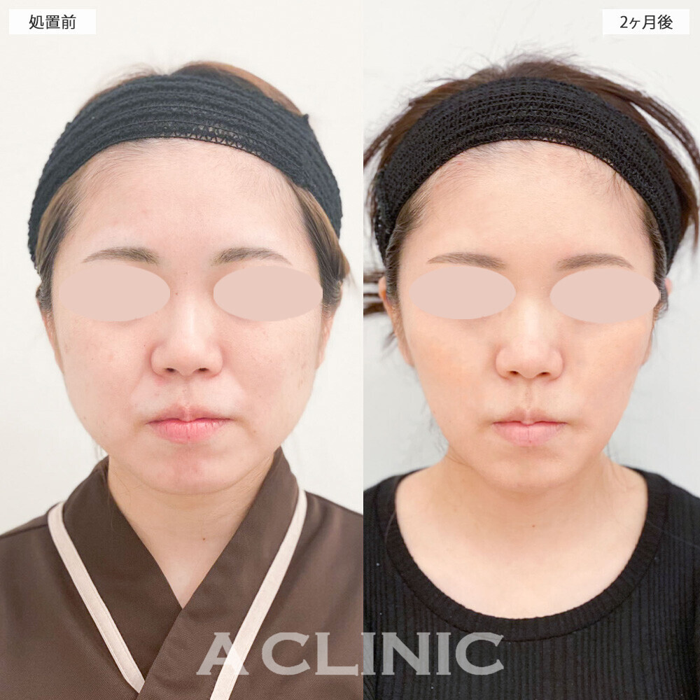 1day小顔脂肪吸引でフェイスラインのもたつきがスッキリしました！こちら処置前から2ヶ月後の症例です。(30代女性)
