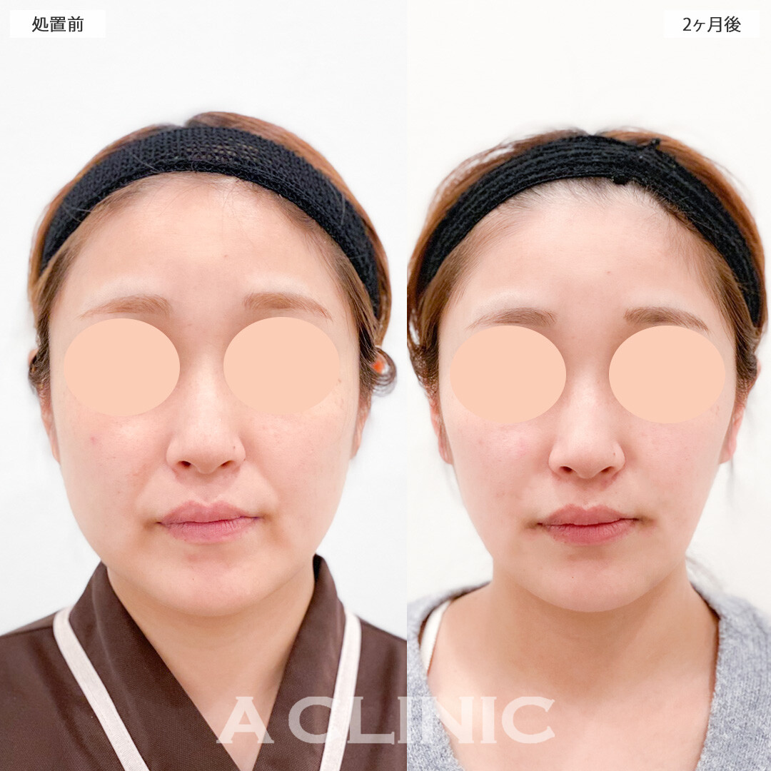 1day小顔脂肪吸引と小顔エラボトックスの組み合わせで徹底的にお顔の余白を解消！処置前と2ヶ月後の症例です(30代女性)