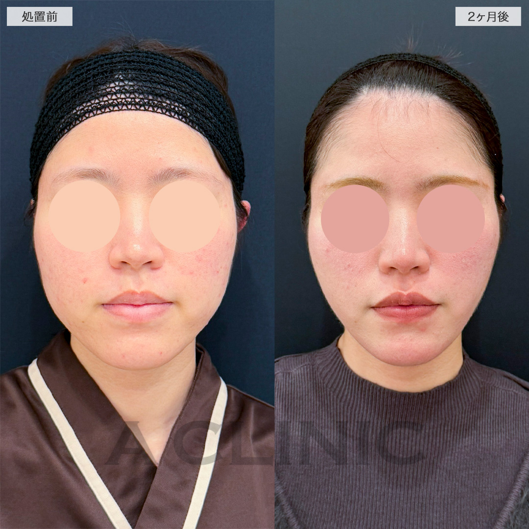 1day小顔脂肪吸引で笑ったときの頬の膨らみが改善！処置前から2ヶ月後の症例です(20代女性)