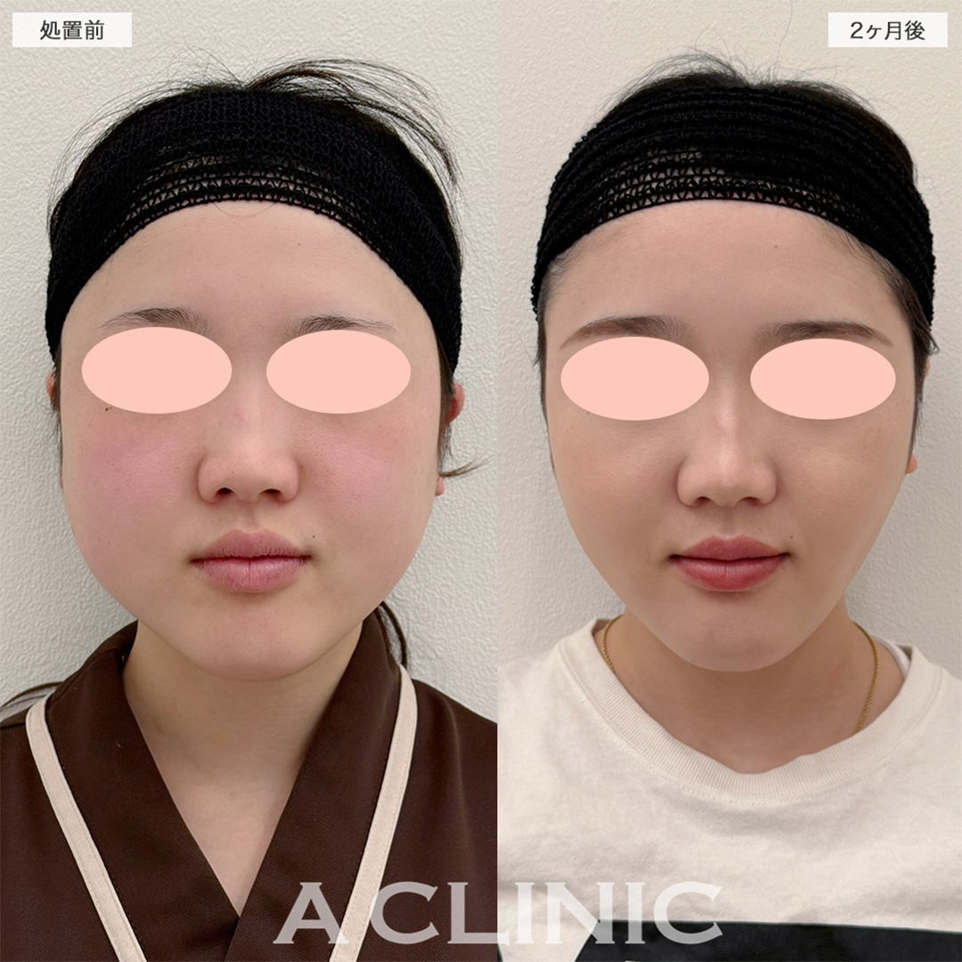 1day小顔脂肪吸引で二回りも小さい輪郭に！こちら処置前と2ヶ月後の症例です(20代女性)