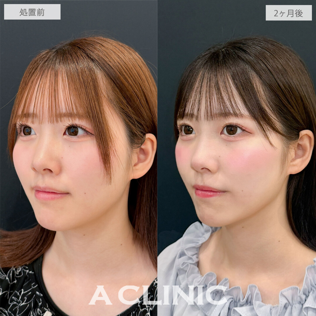 1day小顔脂肪吸引で下膨れ解消！こちら処置前と2ヶ月後の症例です(20代女性)