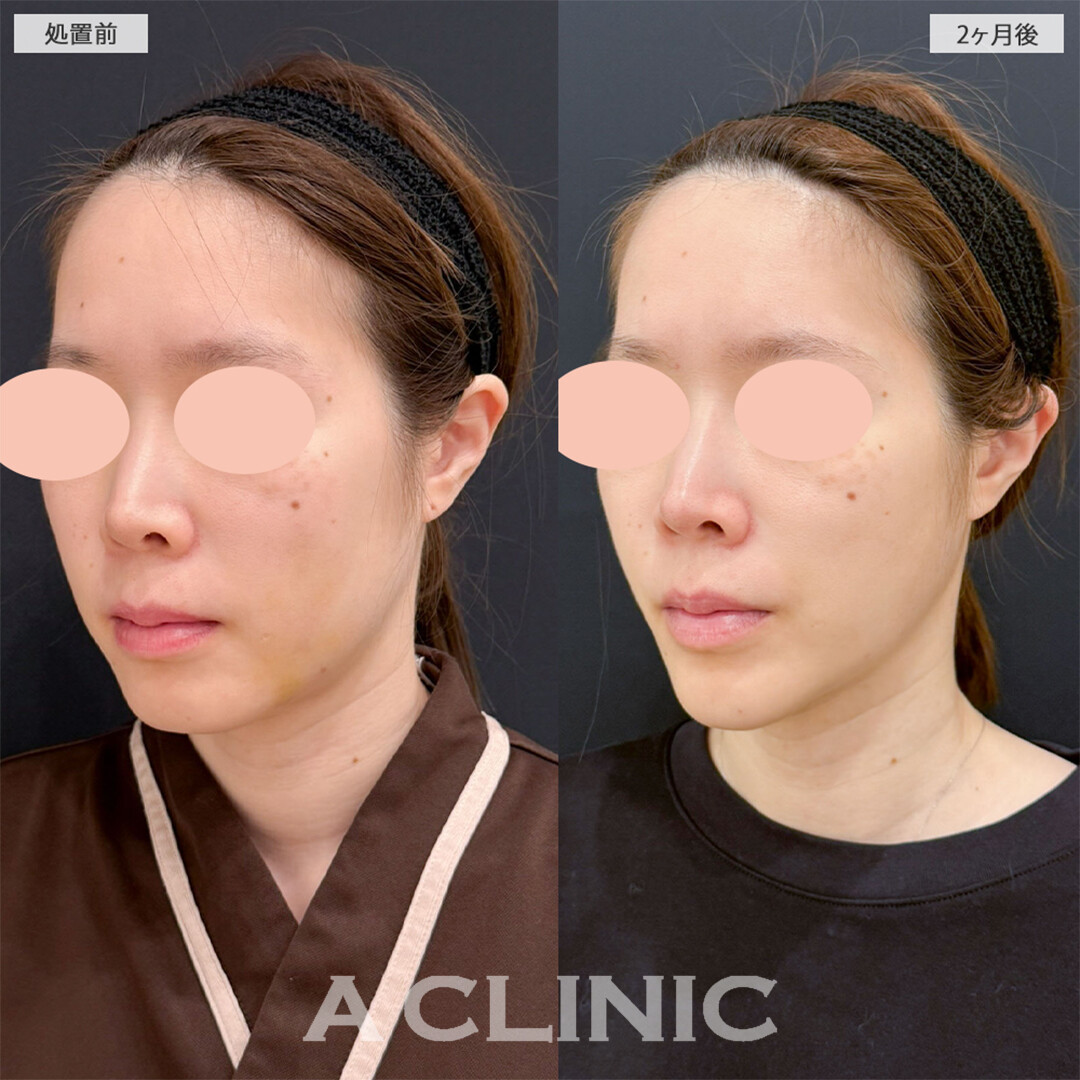 1day小顔脂肪吸引でフェイスラインの骨感もスッキリでました！こちら処置前と2ヶ月後の症例です(30代女性)