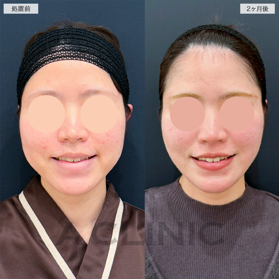 1day小顔脂肪吸引で笑ったときの頬の膨らみが改善！処置前から2ヶ月後の症例です(20代女性)