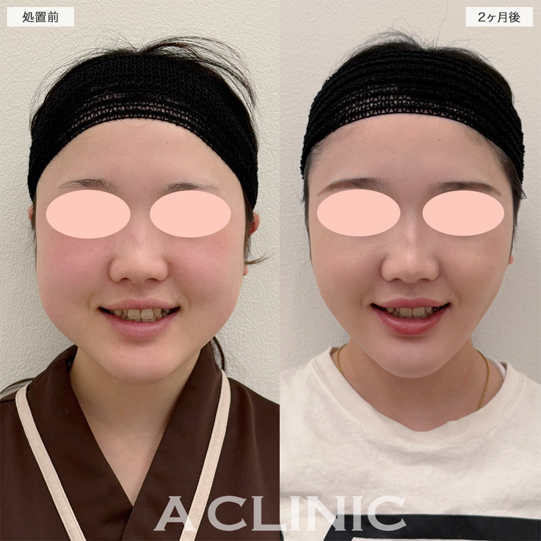 1day小顔脂肪吸引で二回りも小さい輪郭に！こちら処置前と2ヶ月後の症例です(20代女性)