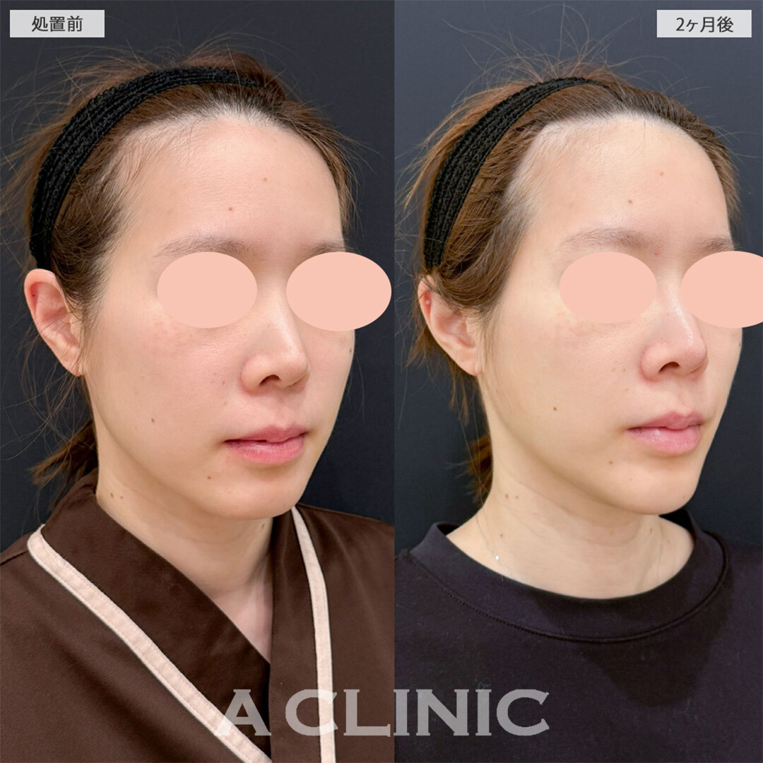 1day小顔脂肪吸引でフェイスラインの骨感もスッキリでました！こちら処置前と2ヶ月後の症例です(30代女性)