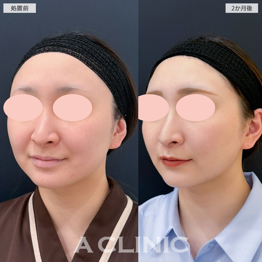 1day小顔脂肪吸引で加工アプリいらずの小顔に！こちら処置前と2ヵ月後の症例です(20代女性)