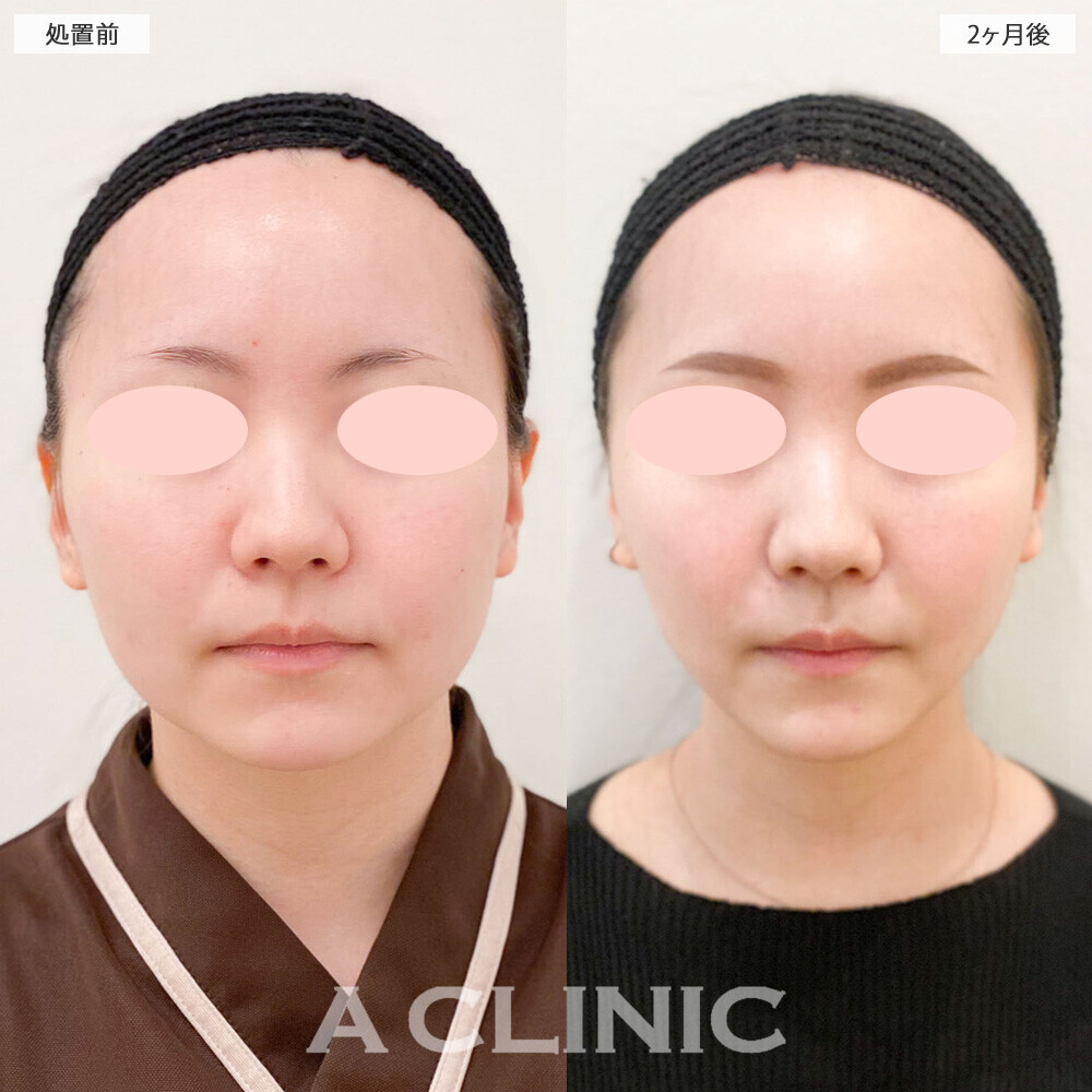 1day小顔脂肪吸引でフェイスラインがスッキリとした印象に！処置前から2ヶ月後の症例です(20代女性)