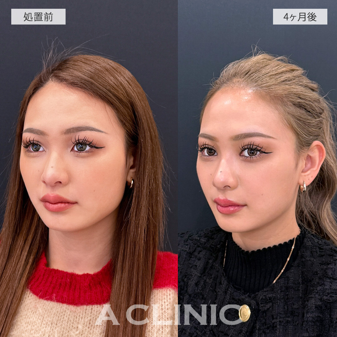 脂肪吸引でシュッとしたフェイスラインへ変身！こちら1day小顔脂肪吸引の処置前と2ヶ月後の症例です(20代女性)