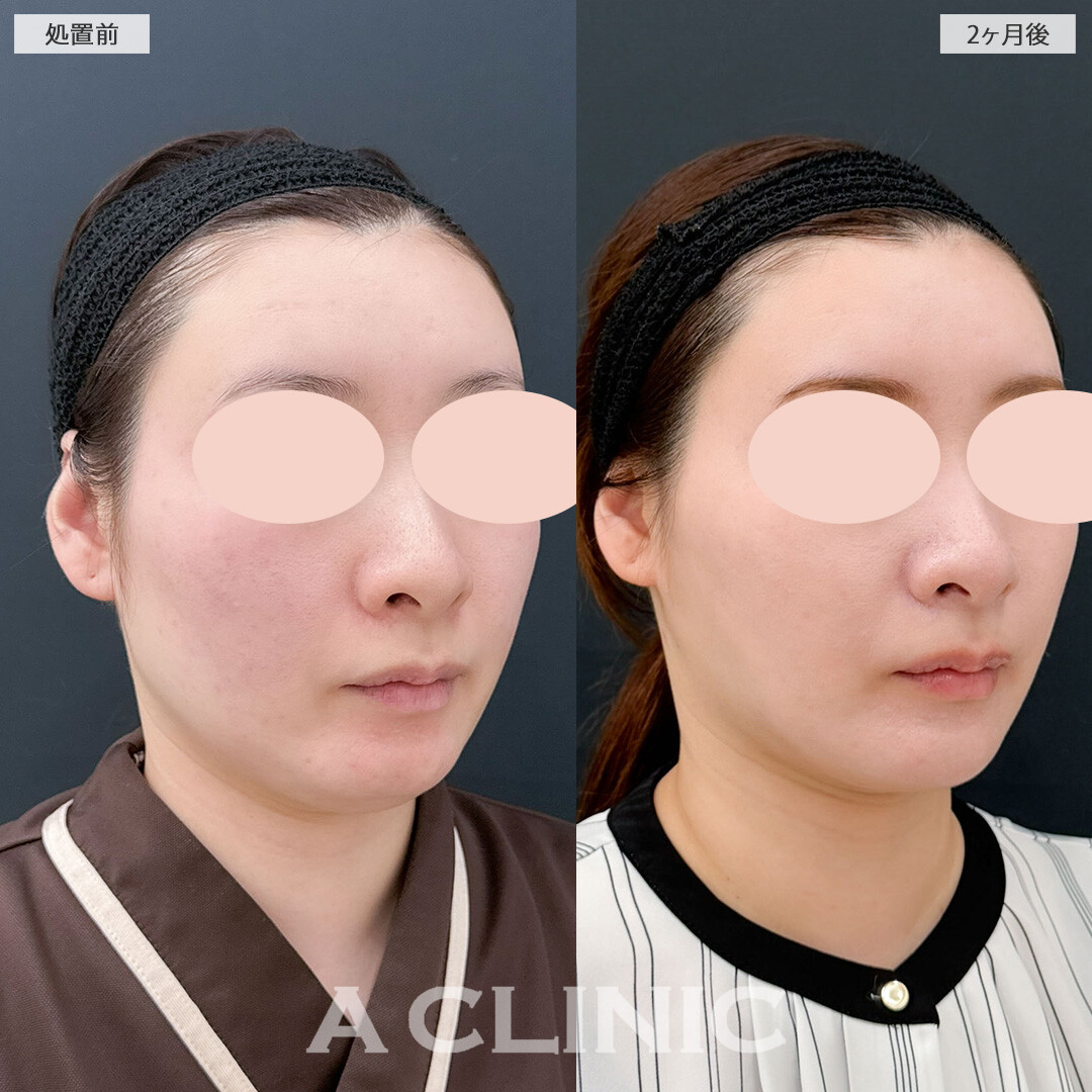 1day小顔脂肪吸引と小顔エラボトックスでお顔を一回り小さくして二重アゴも解消されました！こちら処置前と2ヵ月後の症例です(30代女性)