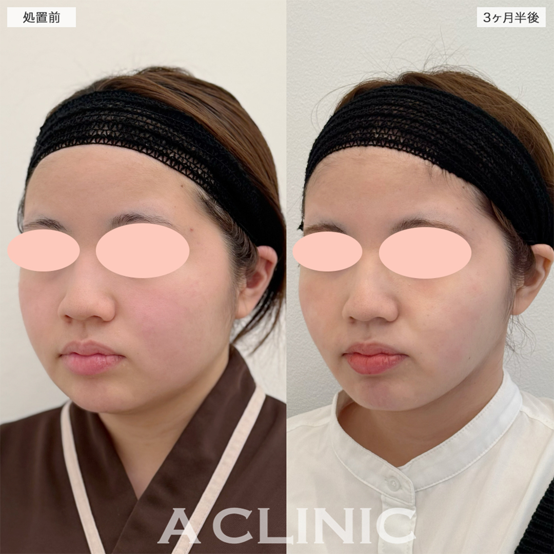 1day小顔脂肪吸引でやっと丸顔から脱出出来ました！こちら処置前と3ヶ月半後の症例です(20代女性)