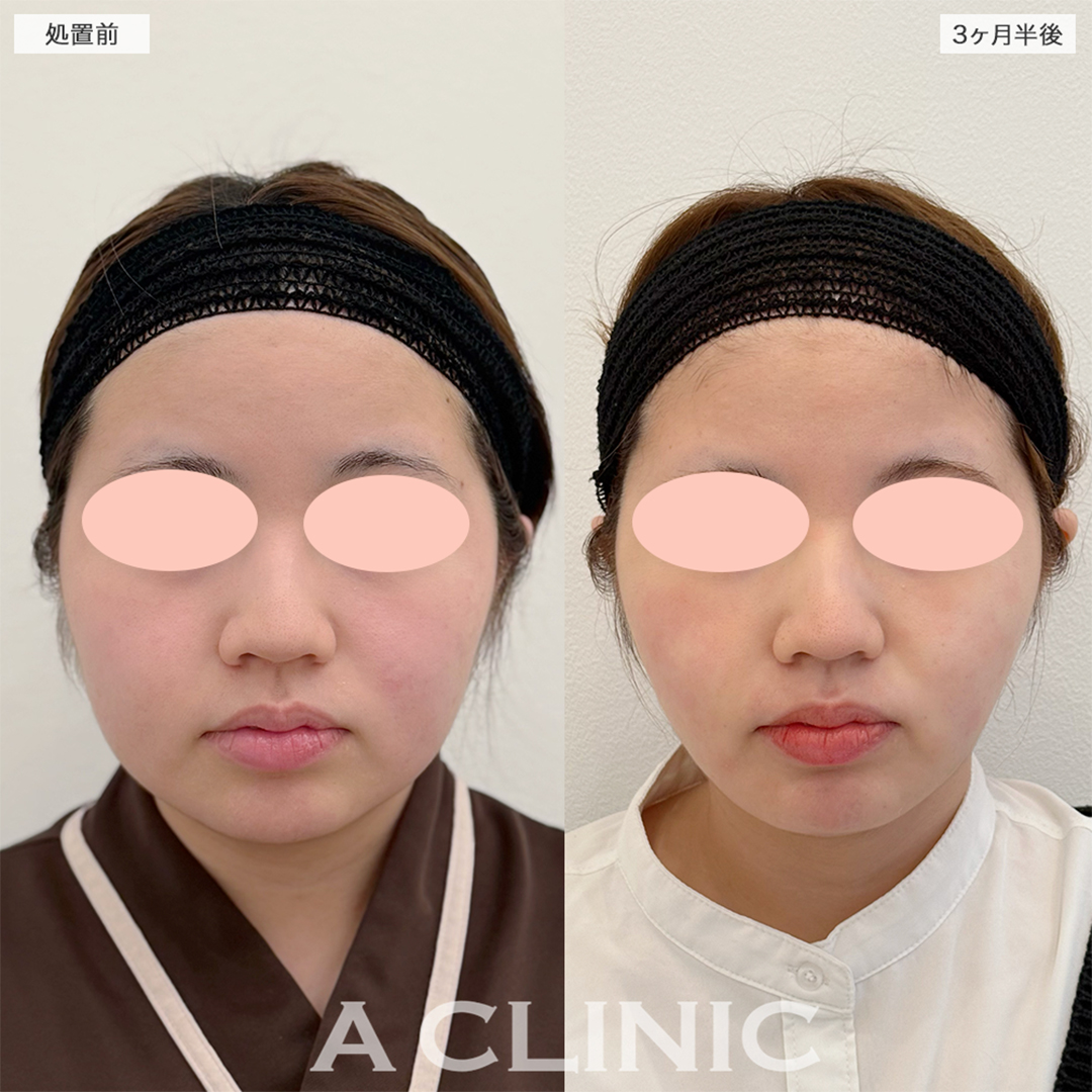 1day小顔脂肪吸引でやっと丸顔から脱出出来ました！こちら処置前と3ヶ月半後の症例です(20代女性)