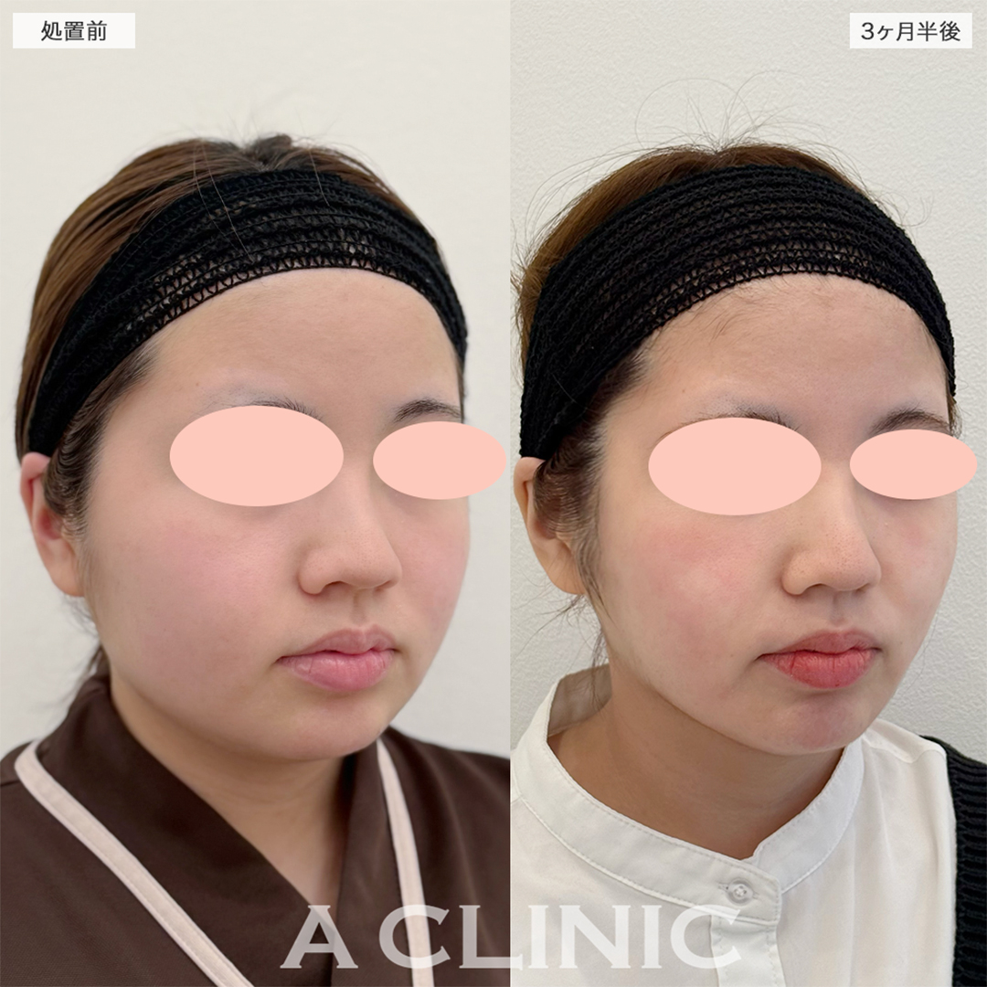1day小顔脂肪吸引でやっと丸顔から脱出出来ました！こちら処置前と3ヶ月半後の症例です(20代女性)