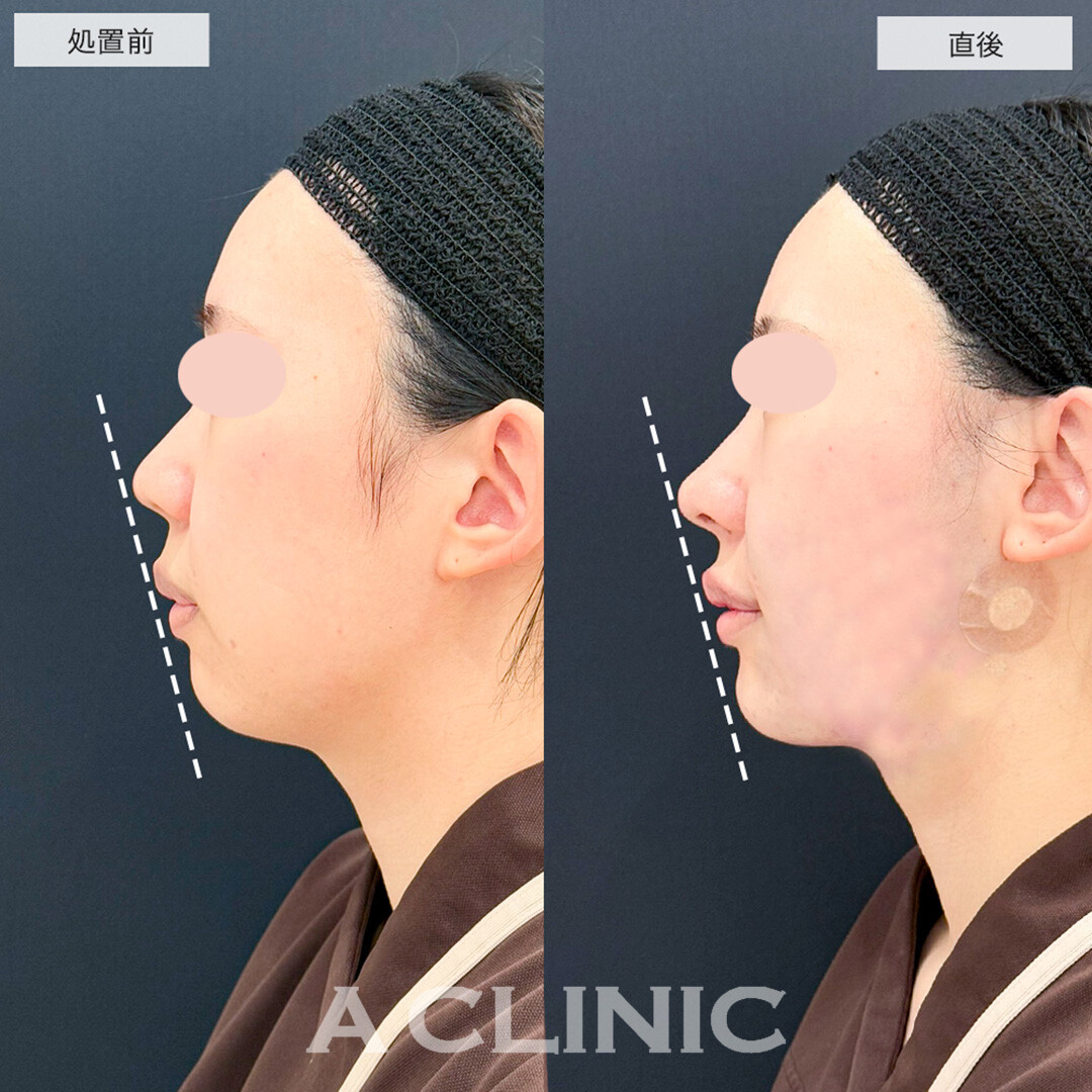 1day小顔脂肪吸引とあごへのヒアルロン酸注入で直後から輪郭スッキリ!こちら処置前と直後の症例です(20代女性)