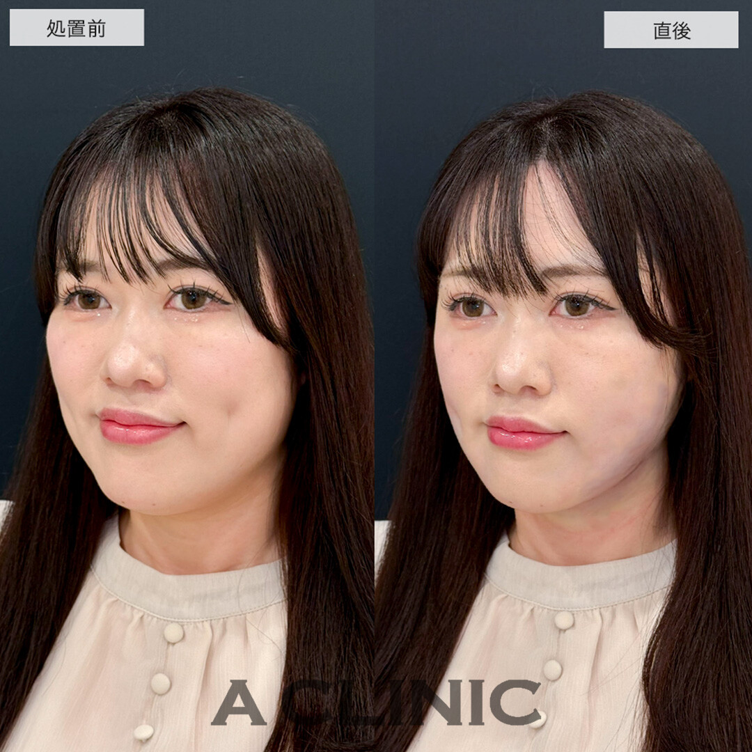 1day小顔脂肪吸引で直後から固定バンド不要で理想の小顔に!こちら処置前と直後の症例です(30代女性)