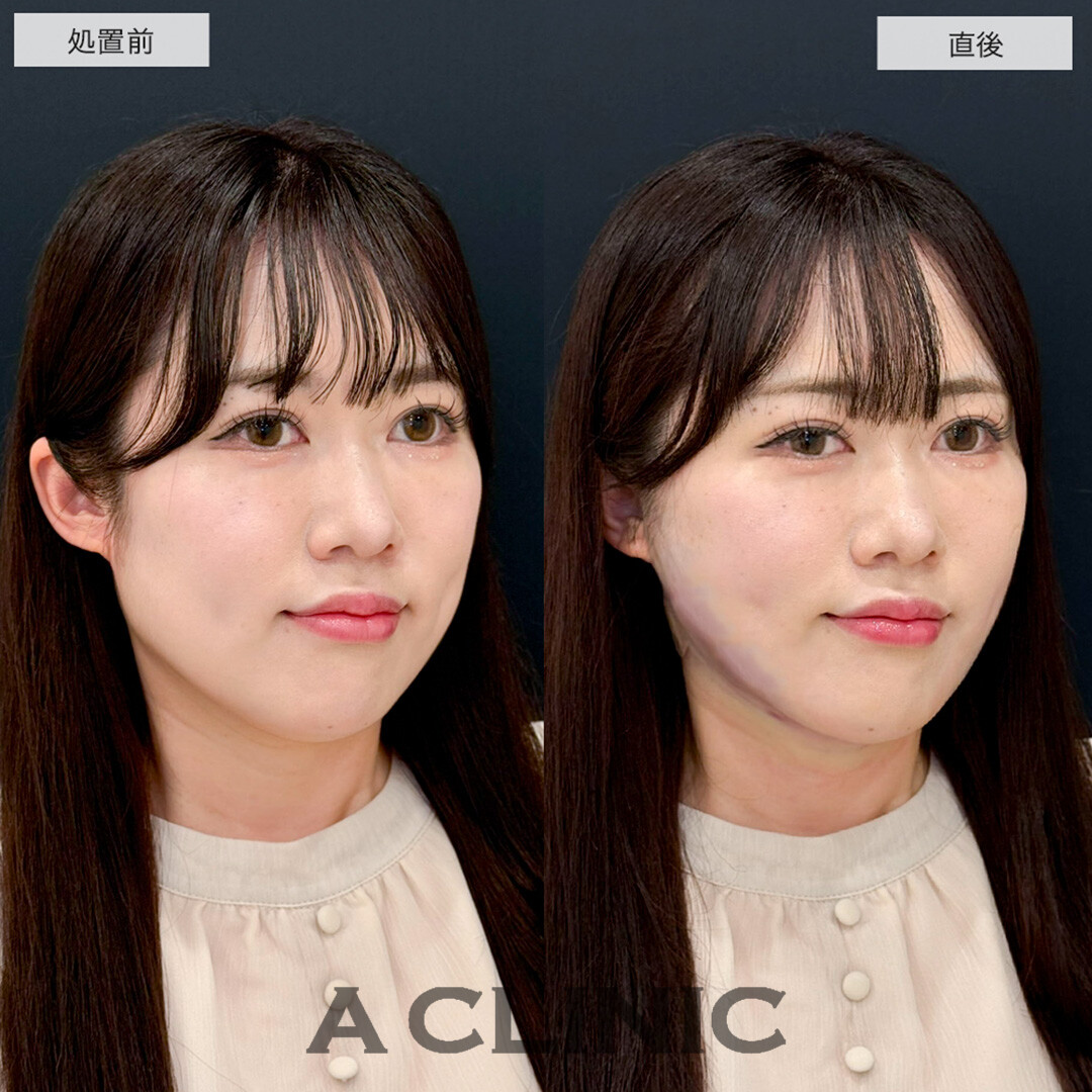1day小顔脂肪吸引で直後から固定バンド不要で理想の小顔に!こちら処置前と直後の症例です(30代女性)