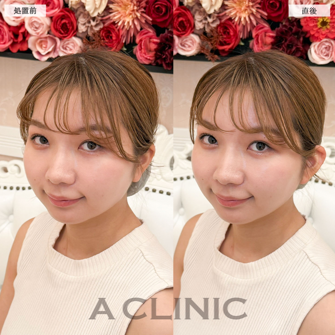 立ち耳ヒアルロン酸注入(ボリューマ)で小顔効果！こちら処置前と直後の症例です(20代女性)