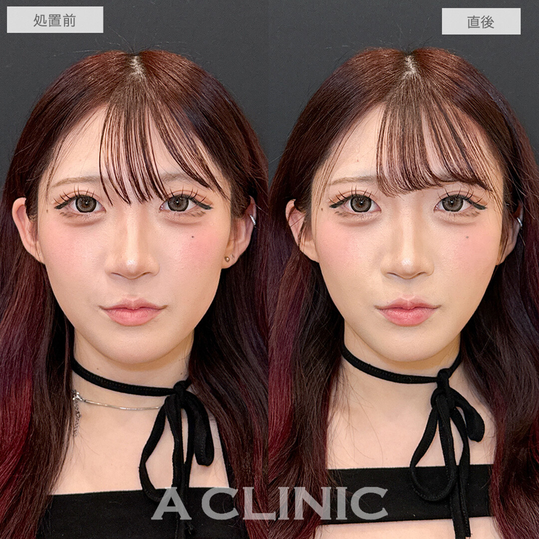 Aスレッドと頬へのヒアルロン酸注入で頬コケ解消！こちら処置前と直後の症例です(10代女性)