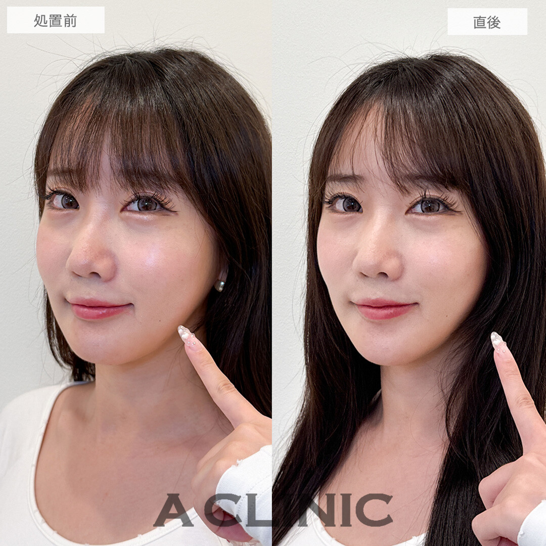 Aスレッドで綺麗なVフェイスに！こちら処置前と直後の症例です(20代女性)