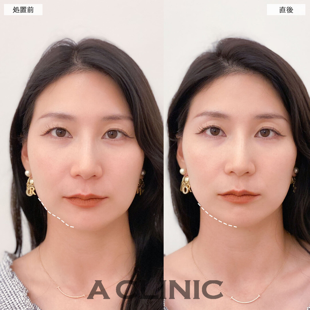 Aスレッドで気になるもたつきを解消します！処置前と直後の症例です(30代女性)