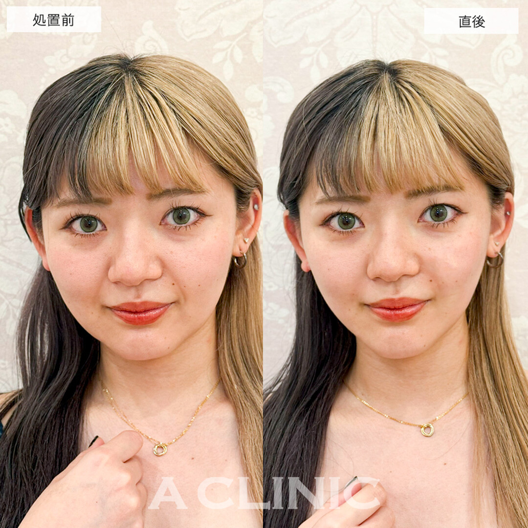 Aスレッドでほうれい線が改善しマイナス5歳若返りました!こちら処置前と直後の症例です(30代女性)