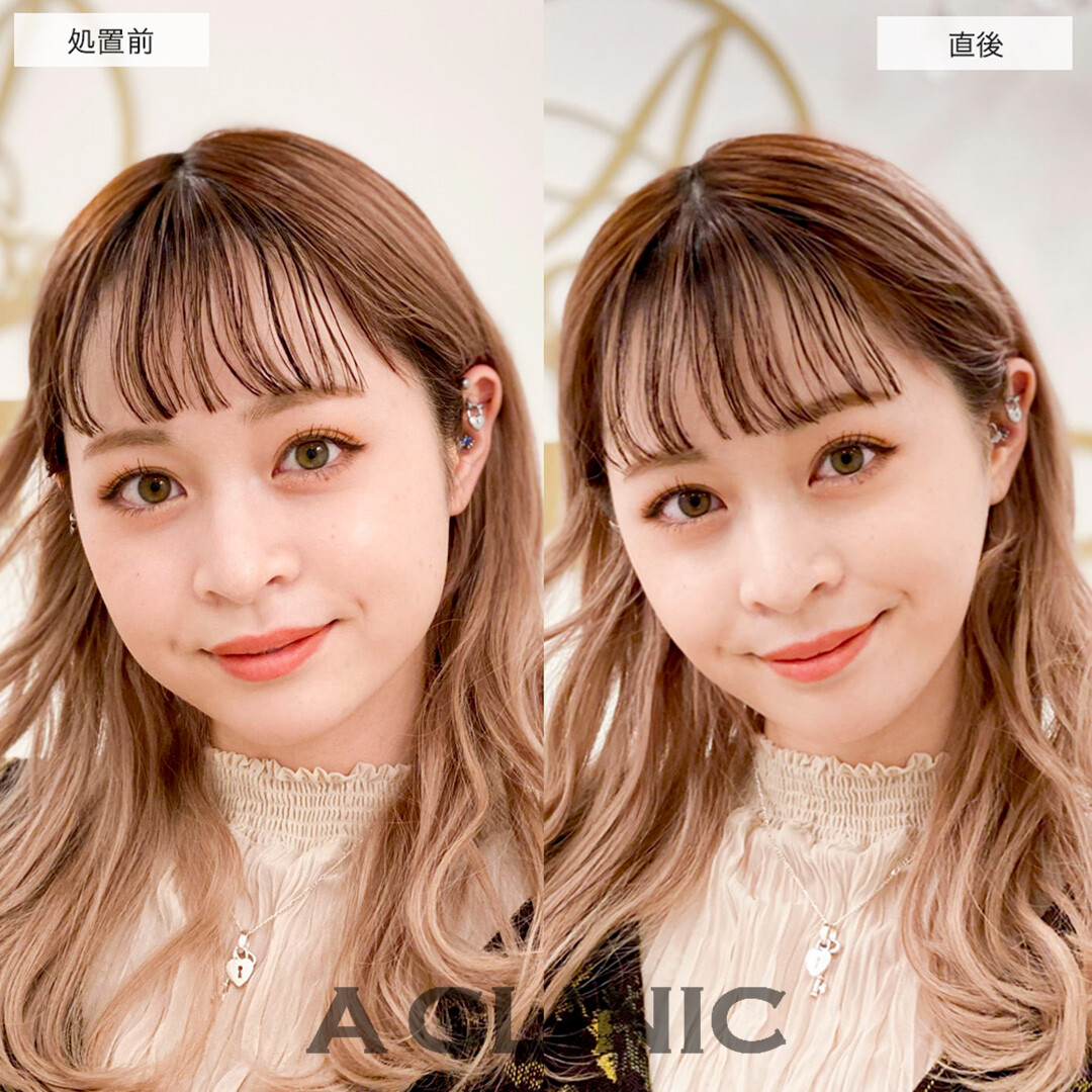 Aスレッドでたるみ解消し垢抜けた印象に!こちら処置前と直後の症例です(20代女性)
