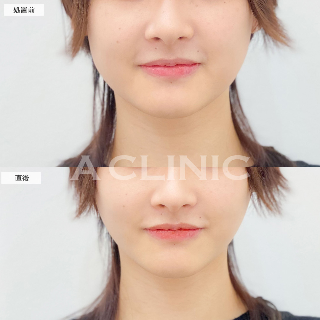 Aスレッドで加工アプリ級の小顔に！こちら処置前と直後の症例です(20代女性)