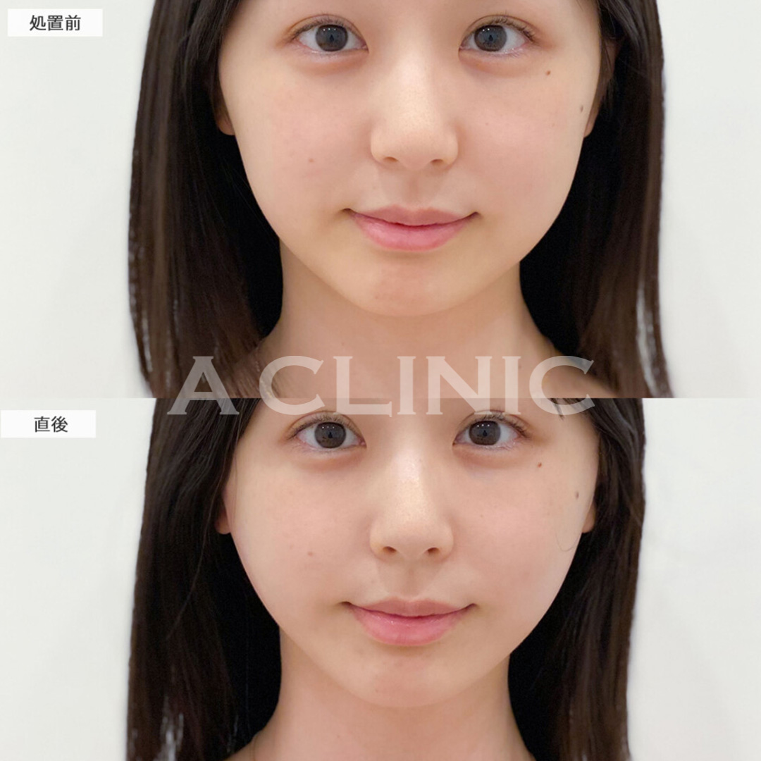 Aスレッドでフェイスライン整えて一気に垢抜け！処置前と直後の症例です(20代女性)