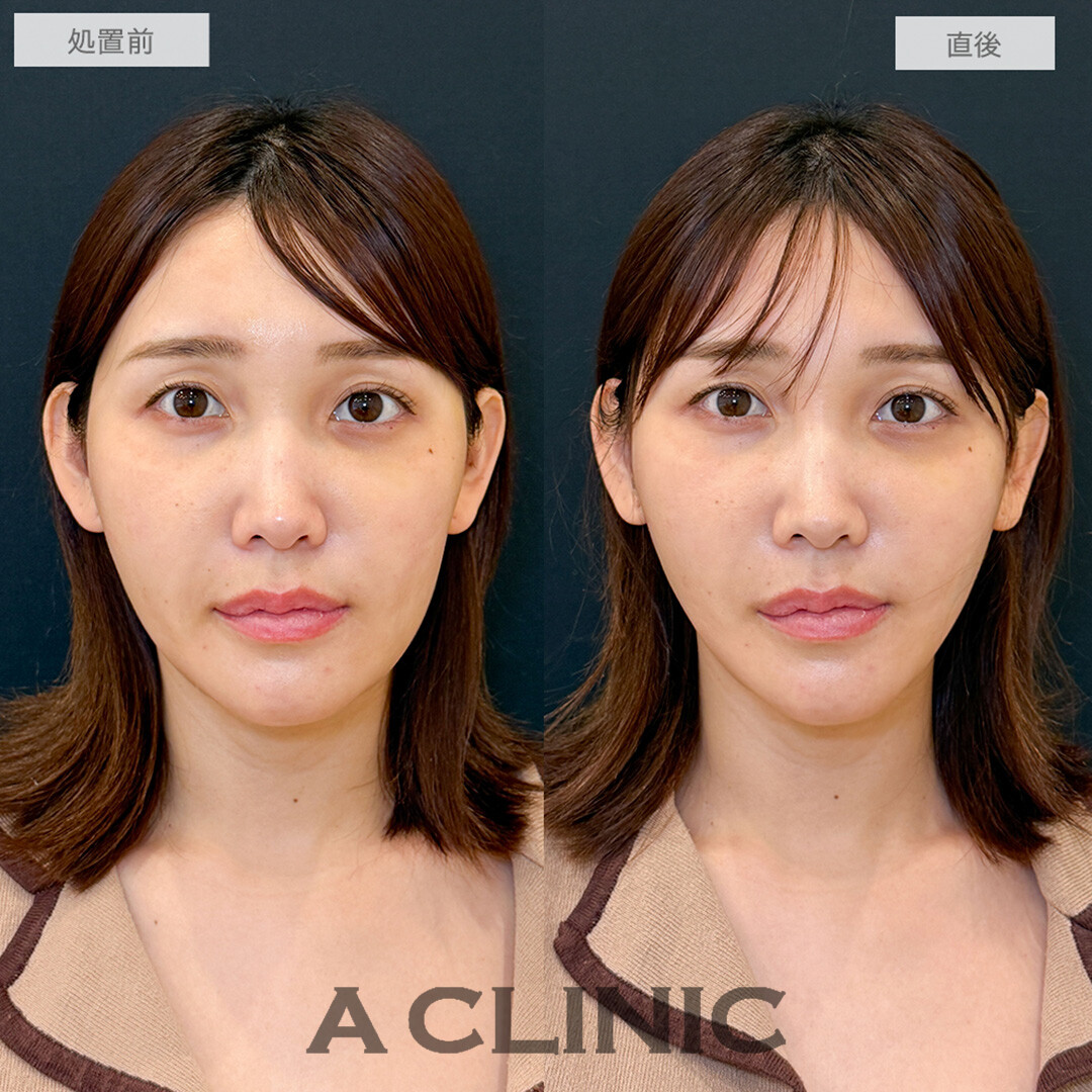 Aスレッドで輪郭の左右差改善！こちら処置前と直後の症例です(30代女性)