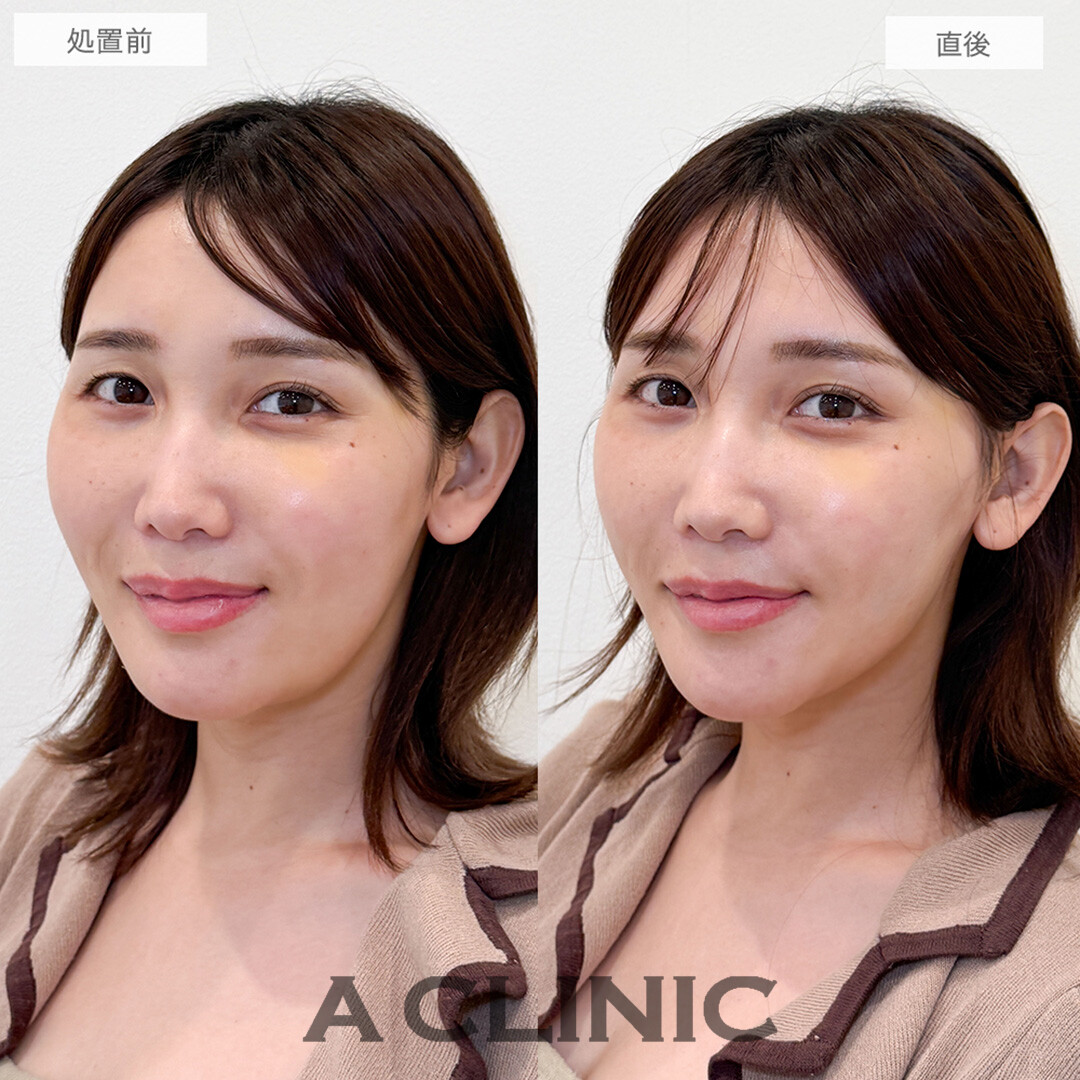 Aスレッドで輪郭の左右差改善！こちら処置前と直後の症例です(30代女性)