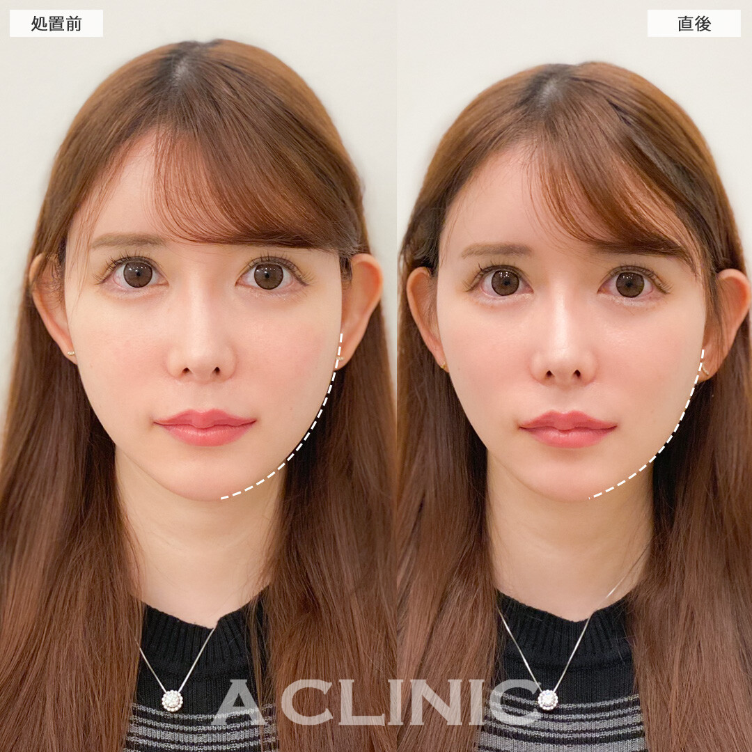 Aスレッドでたるみを引き上げて顔の余白も減りました！処置前と直後の症例です(20代女性)
