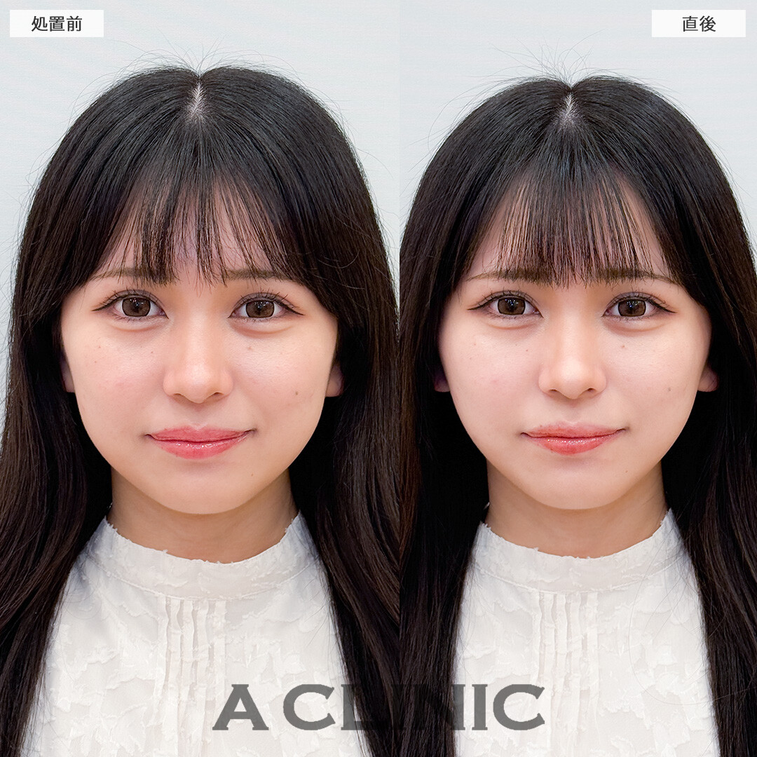 Aスレッドでシュッとした細い顎先になれました！処置前と直後の症例です(20代女性)