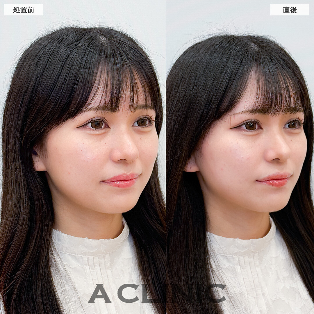 Aスレッドでシュッとした細い顎先になれました！処置前と直後の症例です(20代女性)