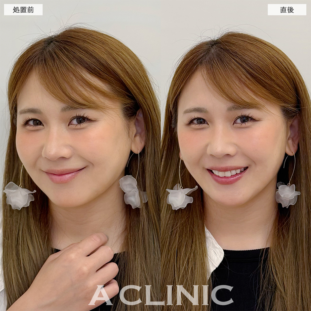 Aスレッドでほうれい線が薄くなり若返りました！こちら処置前と直後の症例です(30代女性)