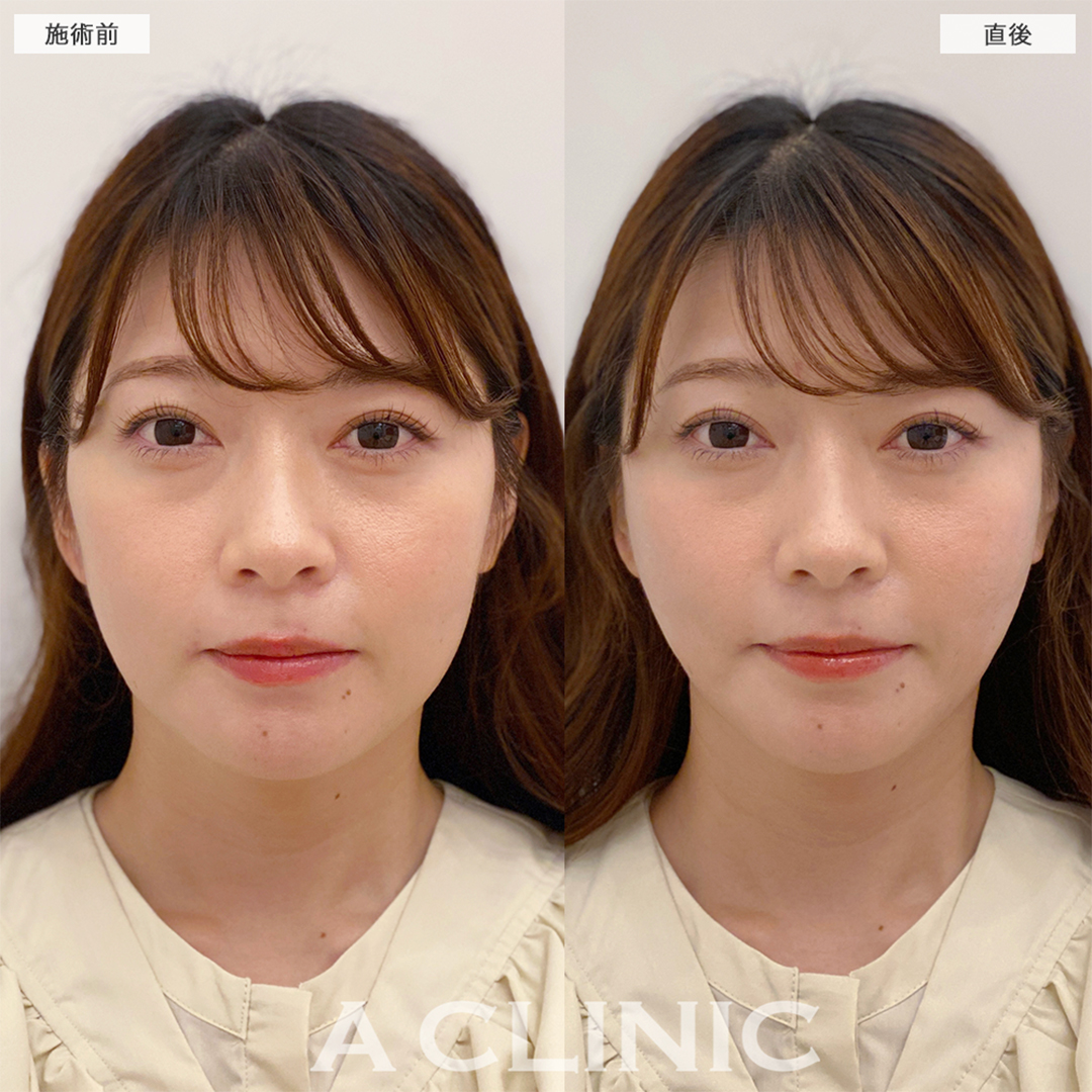 Aスレッドは人中短縮にも効果あり！こちら処置前と直後の症例です(30代女性)