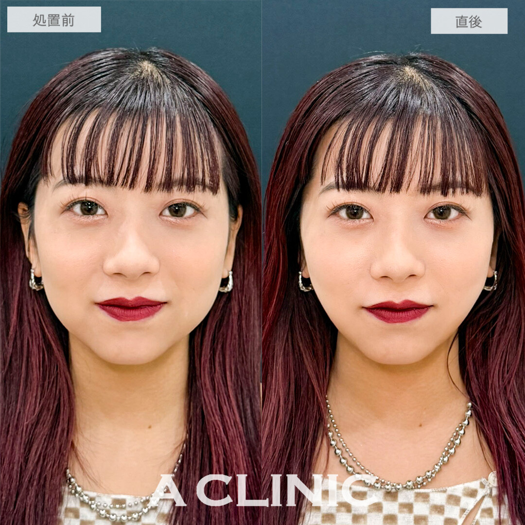 Aスレッドで口横のもたつきと左右差が解消して輪郭が整いました！処置前と直後の症例です(20代女性)