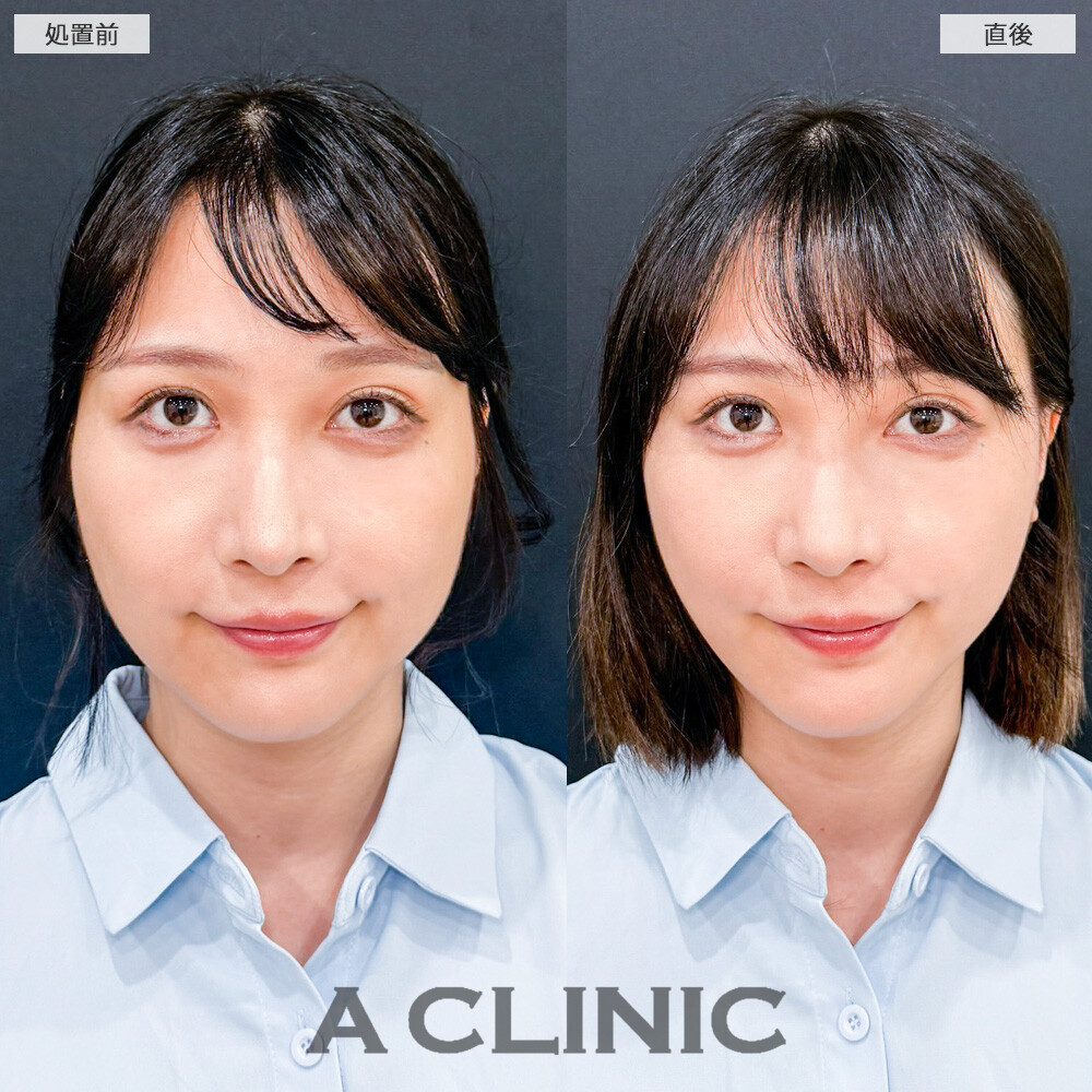 Aスレッドでたるんだお肉が引き上がってあの頃のフェイスラインを取り戻しました！こちら処置前と直後の症例です(30代女性)