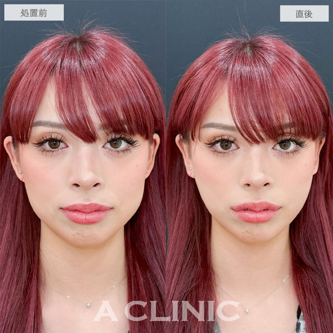 Aスレッドでぼやけていたフェイスラインがくっきり！こちら処置前と直後の症例写真です(20代女性)