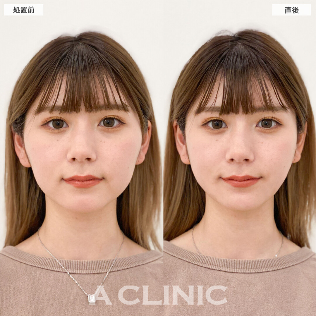 Aスレッドとあごへのヒアルロン酸注入で引き締まった輪郭に！こちら処置前と直後の症例です(20代女性)