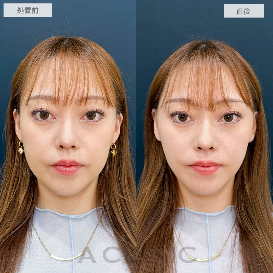 Aスレッドでほうれい線や輪郭のもたつきを解消！処置前と直後の症例です(30代女性)