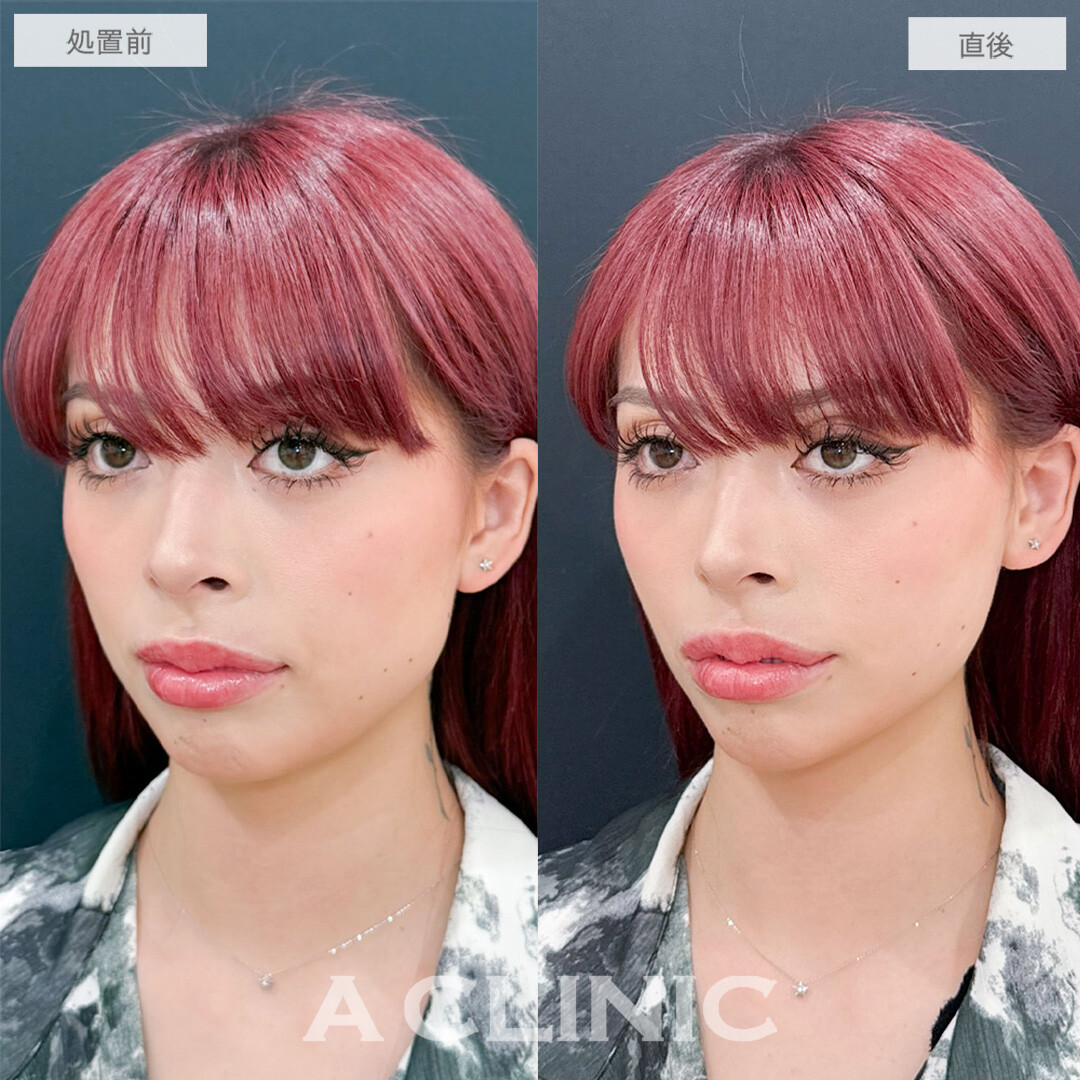 Aスレッドでぼやけていたフェイスラインがくっきり！こちら処置前と直後の症例写真です(20代女性)