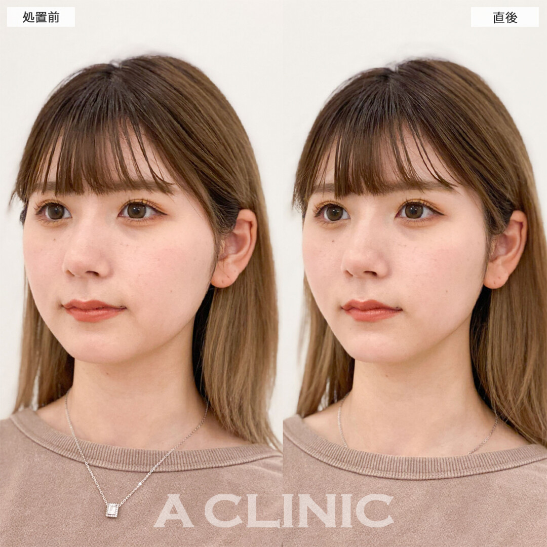 Aスレッドとあごへのヒアルロン酸注入で引き締まった輪郭に！こちら処置前と直後の症例です(20代女性)