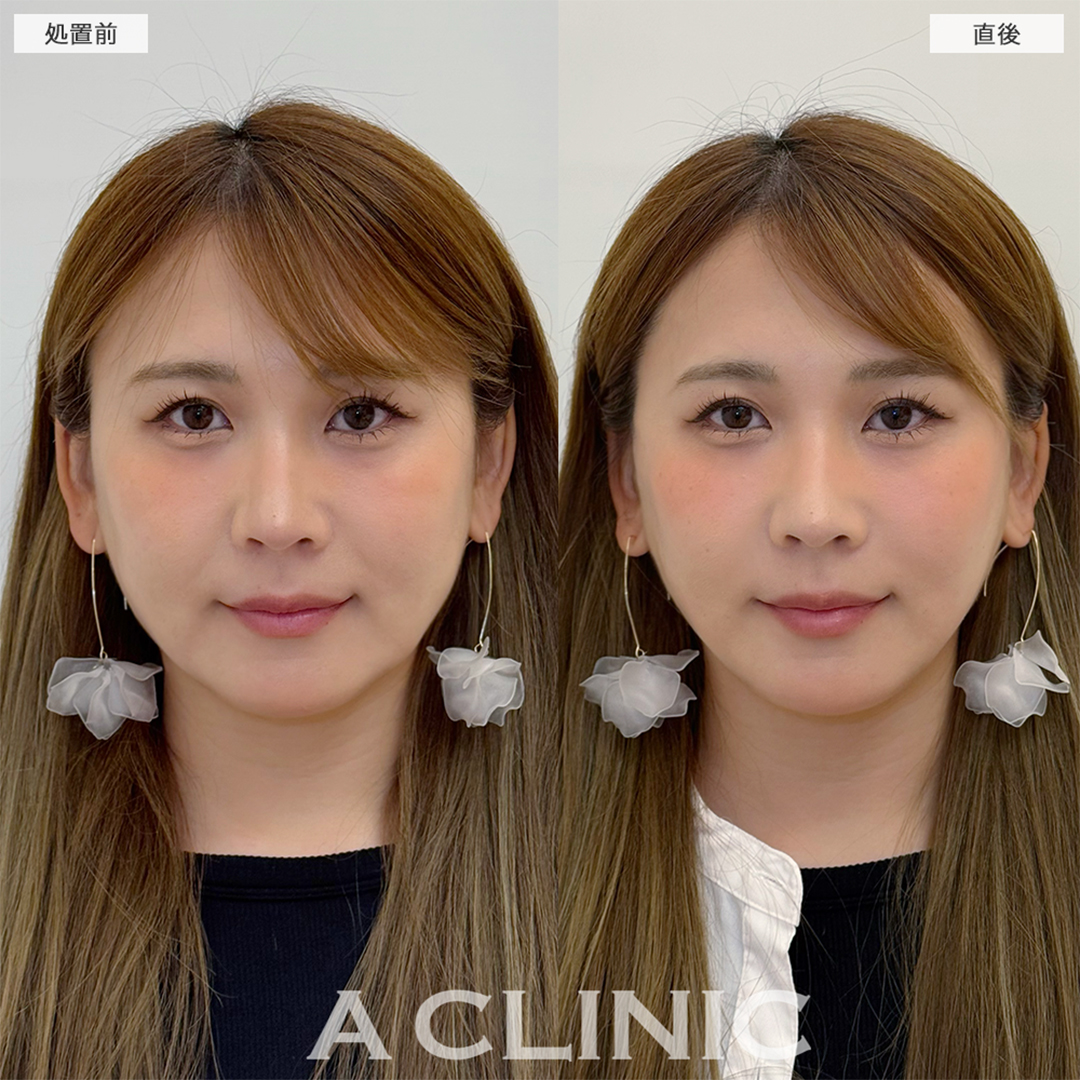Aスレッドでほうれい線が薄くなり若返りました！こちら処置前と直後の症例です(30代女性)