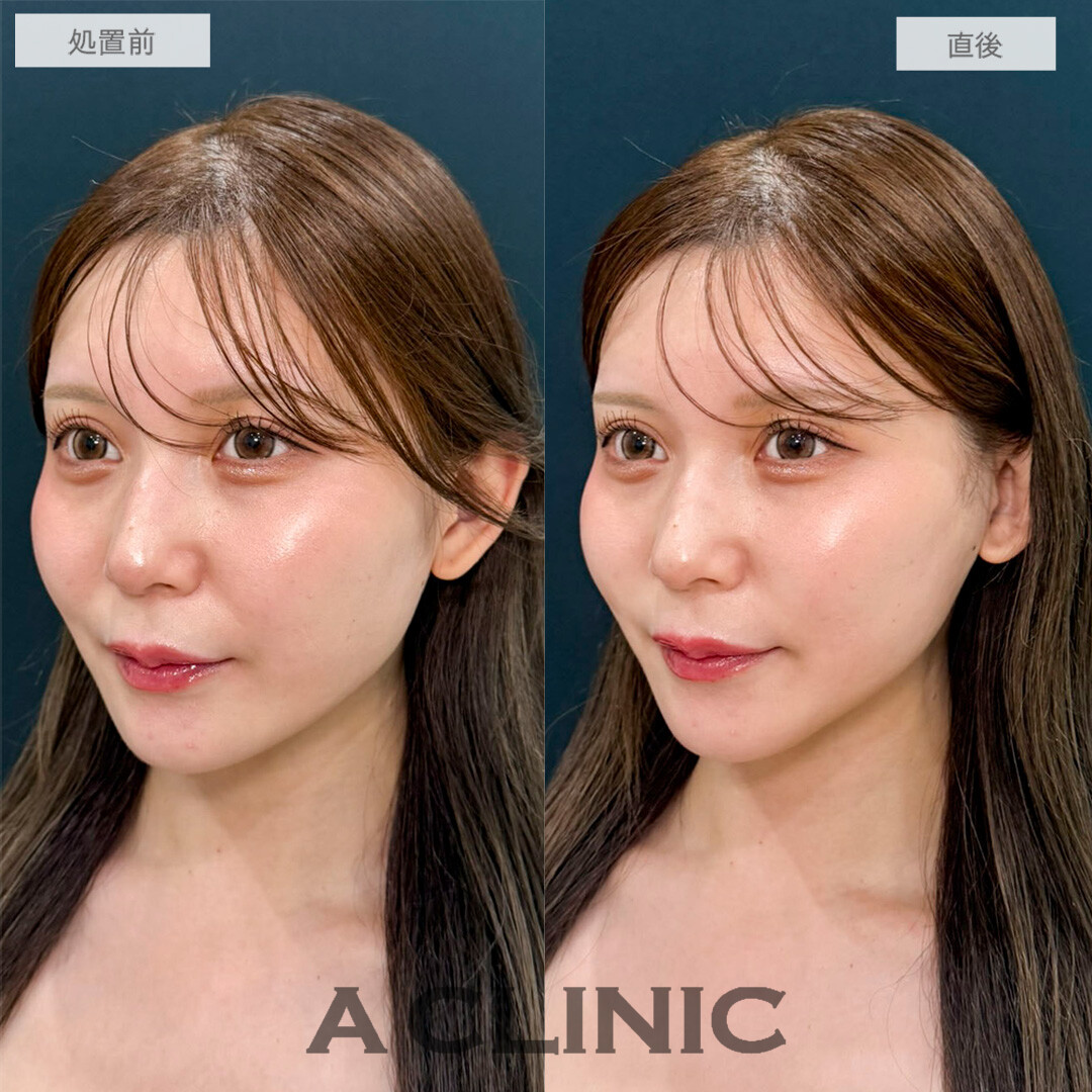 Aスレッドで口横のもたつき感が解消して輪郭が整いました！処置前と直後の症例です(20代女性)