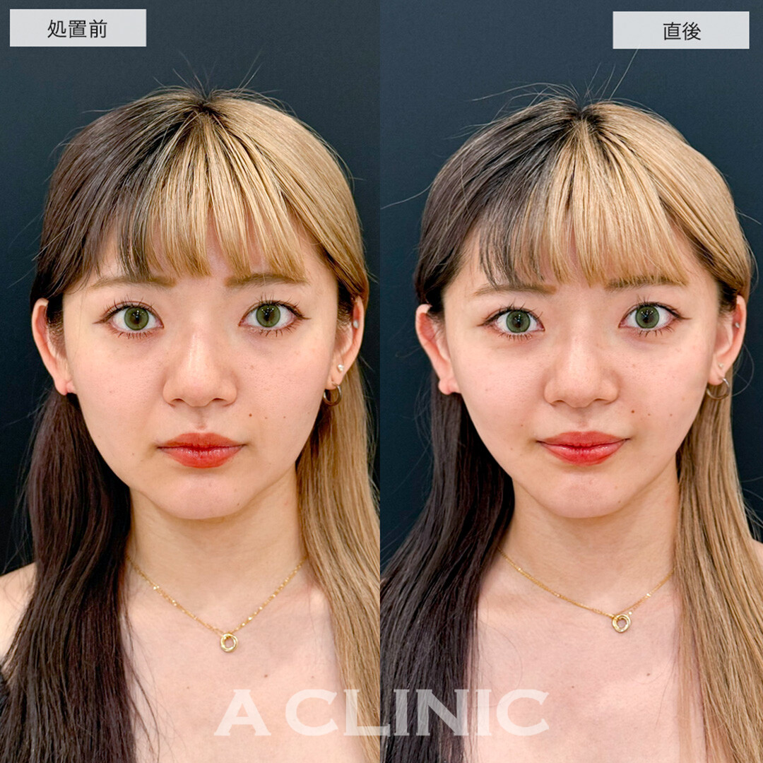 Aスレッドでほうれい線が改善しマイナス5歳若返りました!こちら処置前と直後の症例です(30代女性)
